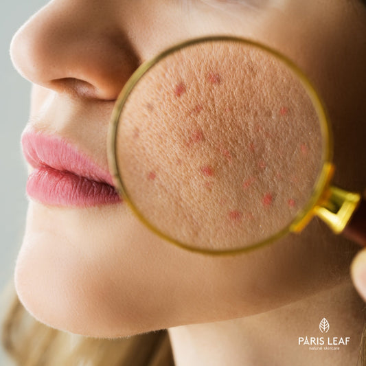 Home Skincare and Professional Acne Treatments